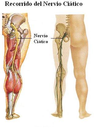 Consecuencias de una inyección mal puesta en el nervio ciático