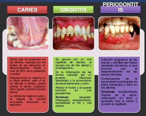 Enfermedades causadas por las caries dentales
