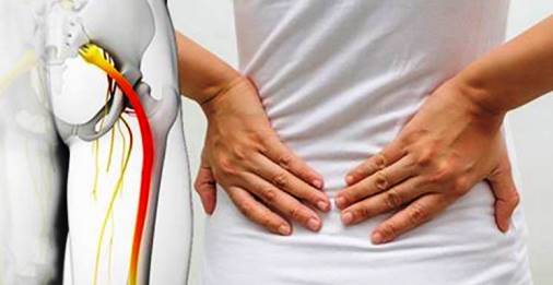 ¿Por qué se daña el nervio ciático?