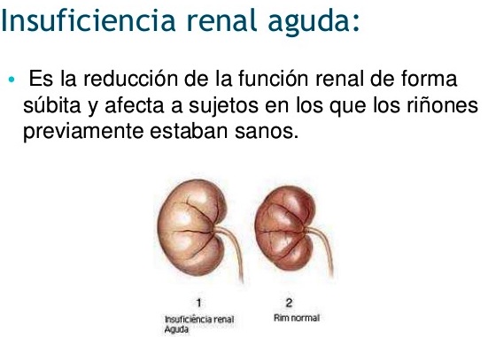 ¿Qué es la insuficiencia renal aguda?