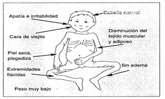 ¿Cuáles son las características de la desnutrición?