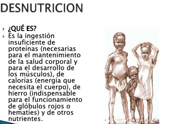 La desnutrición