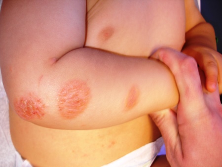 La leche materna no protege contra el eczema
