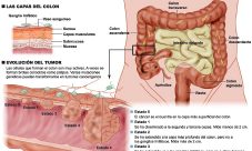 Síntomas del cáncer de colon