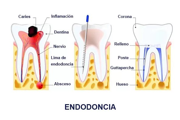 ¿Cómo perder el miedo a la endodoncia?